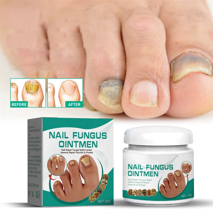 Nail Fungus Treatment Ointment