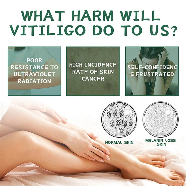 White Spot Removal Skin Vitiligo Cream